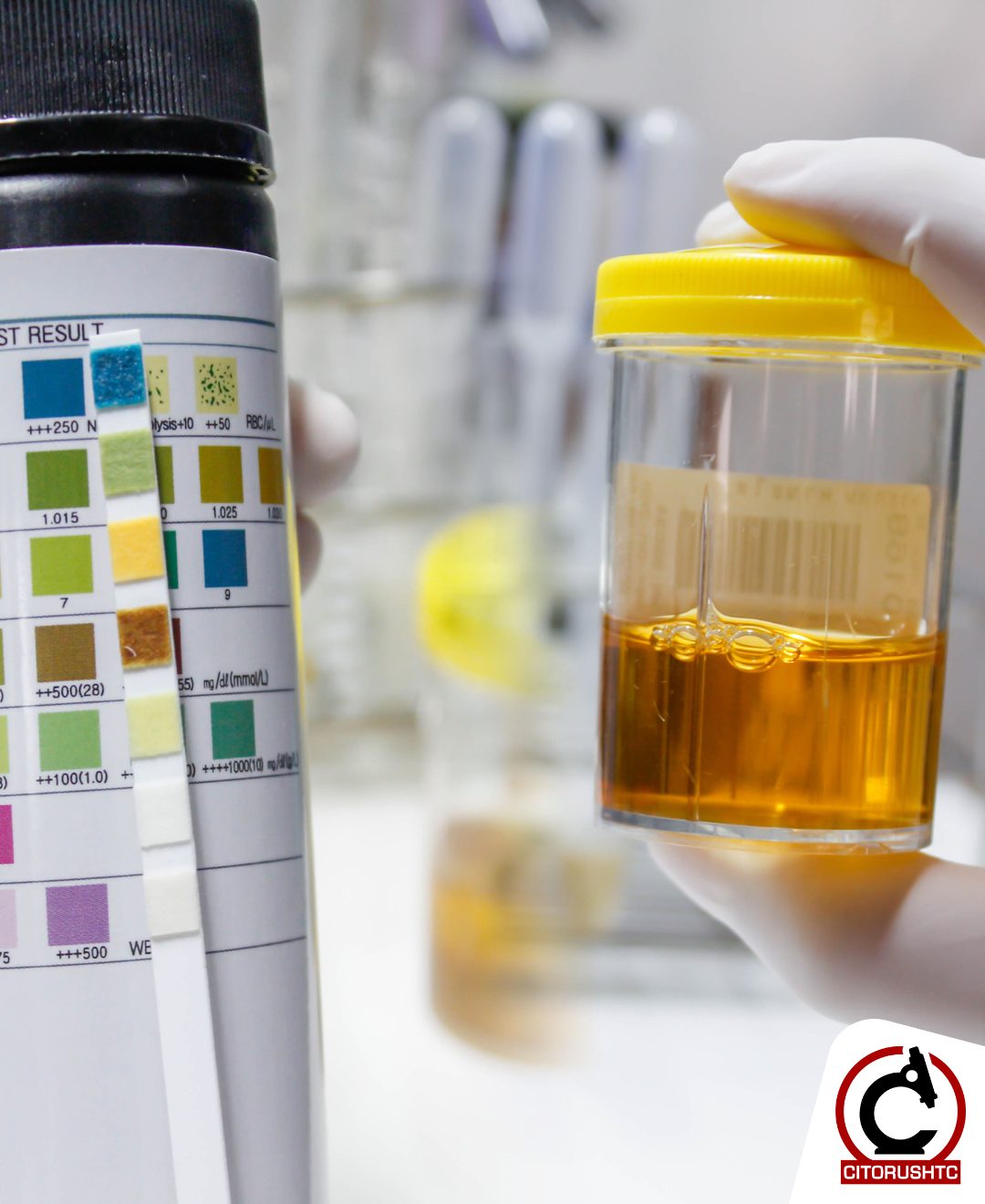 Investigadores vallisoletanos descubren en la orina la clave para detectar el daño renal antes de que sea tarde