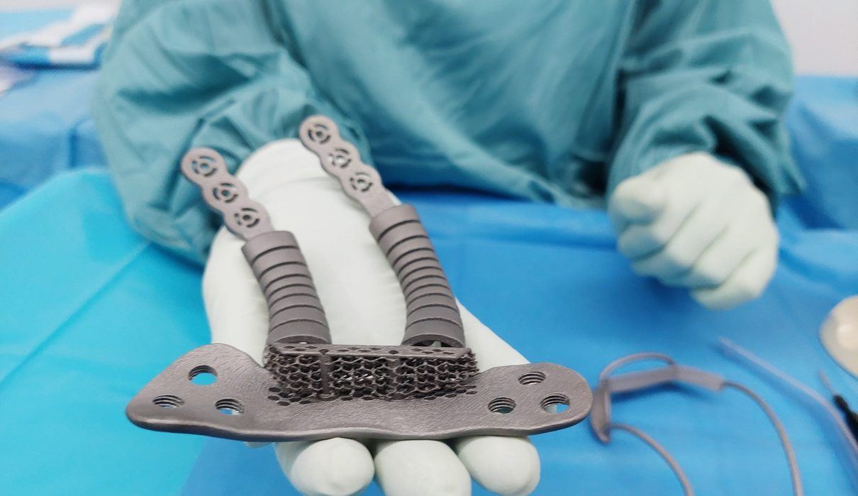 Un hospital madrileño crea la prótesis ósea más avanzada del mundo y salva la pierna de un paciente de 38 años