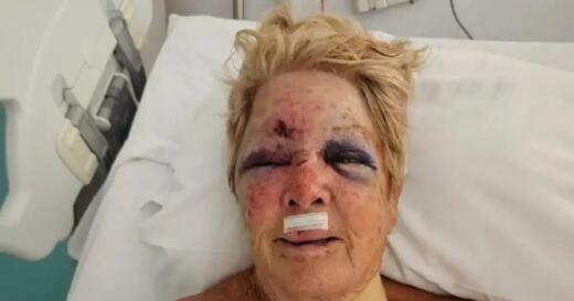 Una anciana de 82 años acaba en el quirófano tras cinco semanas sin ascensor en su edificio de Maó